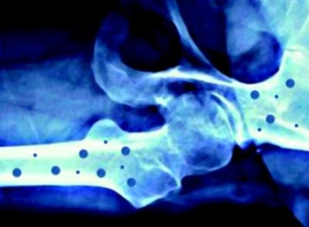 osteoporosi-31.630x360